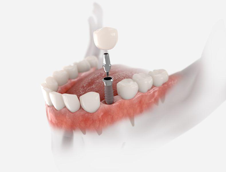 Implant zęba